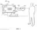 Fig. 02 - Proximal Mounting of Temperature Sensor in Intravascular Temperature Management Catheter