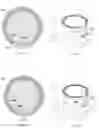 Fig. 07 - Lasik flap cutting patterns including intrastromal pocket for bubble management