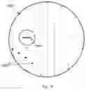 Fig. 12 - Lasik flap cutting patterns including intrastromal pocket for bubble management