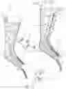 Fig. 11 - Thermoformable orthosis apparatus and method of use