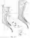 Fig. 13 - Thermoformable orthosis apparatus and method of use