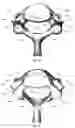 Fig. 05 - Systems and Methods for Relieving Nerve Tension in Scoliosis