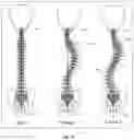 Fig. 16 - Systems and Methods for Relieving Nerve Tension in Scoliosis