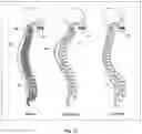 Fig. 17 - Systems and Methods for Relieving Nerve Tension in Scoliosis