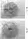 Fig. 06 - CUP ATTACHMENT FOR MASSAGER