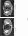 Fig. 05 - EZH2 inhibitors for treating lymphoma