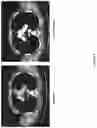 Fig. 06 - EZH2 inhibitors for treating lymphoma