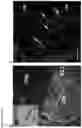 Fig. 07 - Methods of treating optic nerve diseases using neural progenitor cell growth factors