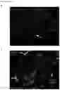 Fig. 13 - Methods of treating optic nerve diseases using neural progenitor cell growth factors