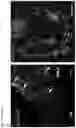 Fig. 17 - Methods of treating optic nerve diseases using neural progenitor cell growth factors