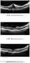 Fig. 07 - METHOD OF TREATING CONDITIONS OF THE EYE WITH AN ANTI-VEGF DARPIN