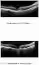 Fig. 08 - METHOD OF TREATING CONDITIONS OF THE EYE WITH AN ANTI-VEGF DARPIN