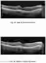 Fig. 11 - METHOD OF TREATING CONDITIONS OF THE EYE WITH AN ANTI-VEGF DARPIN