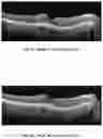 Fig. 12 - METHOD OF TREATING CONDITIONS OF THE EYE WITH AN ANTI-VEGF DARPIN