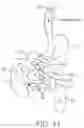 Fig. 18 - THERAPEUTIC AGENT PREPARATIONS FOR DELIVERY INTO A LUMEN OF THE INTESTINAL TRACT USING A SWALLOWABLE DRUG DELIVERY DEVICE