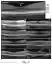 Fig. 22 - ENHANCED HUMAN OPSIN PROMOTER FOR ROD SPECIFIC EXPRESSION