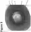 Fig. 04 - DYE ENHANCED VISUALIZATION OF CATARACT SURGERY