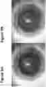 Fig. 10 - DYE ENHANCED VISUALIZATION OF CATARACT SURGERY