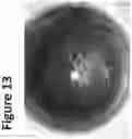 Fig. 14 - DYE ENHANCED VISUALIZATION OF CATARACT SURGERY