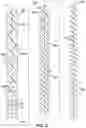 Fig. 06 - Catheter designs for enhanced column strength