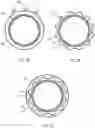 Fig. 04 - MEDICAL DEVICE WITH DRUG-ELUTING COATING ON MODIFIED DEVICE SURFACE