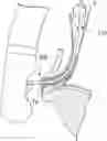Fig. 01 - METHOD FOR FORMING ACCESS ROUTE TO BILE DUCT