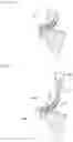 Fig. 16 - METHOD FOR FORMING ACCESS ROUTE TO BILE DUCT