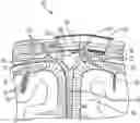 Fig. 01 - Surgical method, device, system and kit for the treatment of hydrocephalus