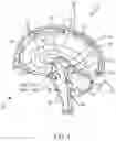 Fig. 02 - Surgical method, device, system and kit for the treatment of hydrocephalus