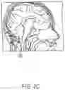 Fig. 04 - Surgical method, device, system and kit for the treatment of hydrocephalus