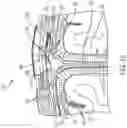 Fig. 17 - Surgical method, device, system and kit for the treatment of hydrocephalus