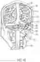 Fig. 20 - Surgical method, device, system and kit for the treatment of hydrocephalus