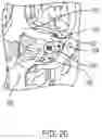 Fig. 22 - Surgical method, device, system and kit for the treatment of hydrocephalus