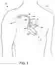 Fig. 04 - Systems and methods for optimizing implantable medical device characteristics using data structures and graphical representations