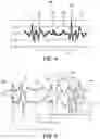 Fig. 05 - Mode switching in a ventricular pacemaker to promote atrioventricular conduction