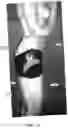 Fig. 35 - Device for delivering precision phototherapy