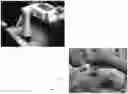 Fig. 04 - METHOD OF TREATMENT OR PREVENTION OF KELOIDS AND HYPERTROPHIC SCARS USING ELECTROMAGNETIC RADIATION