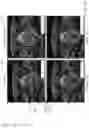 Fig. 14 - Registration free automatic contour adaptation using neural networks