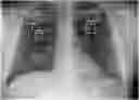 Fig. 01 - Methods of assessing lung disease in chest x-rays