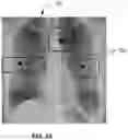 Fig. 06 - Methods of assessing lung disease in chest x-rays