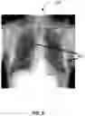 Fig. 11 - Methods of assessing lung disease in chest x-rays