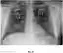 Fig. 13 - Methods of assessing lung disease in chest x-rays
