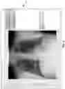 Fig. 14 - Methods of assessing lung disease in chest x-rays