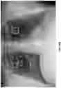 Fig. 22 - Methods of assessing lung disease in chest x-rays