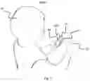 Fig. 17 - Method and device for recognizing a gesture in real-time