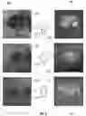 Fig. 06 - COMPUTERIZED SYSTEMS FOR PREDICTION OF GEOGRAPHIC ATROPHY PROGRESSION USING DEEP LEARNING APPLIED TO CLINICAL IMAGING