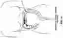 Fig. 71 - METHOD AND APPARATUS FOR MANIPULATING THE SIDE WALL OF A BODY LUMEN OR BODY CAVITY SO AS TO PROVIDE INCREASED VISUALIZATION OF THE SAME AND/OR INCREASED ACCESS TO THE SAME, AND/OR FOR STABILIZING INSTRUMENTS RELATIVE TO THE SAME