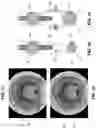 Fig. 77 - METHOD AND APPARATUS FOR MANIPULATING THE SIDE WALL OF A BODY LUMEN OR BODY CAVITY SO AS TO PROVIDE INCREASED VISUALIZATION OF THE SAME AND/OR INCREASED ACCESS TO THE SAME, AND/OR FOR STABILIZING INSTRUMENTS RELATIVE TO THE SAME