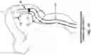Fig. 85 - METHOD AND APPARATUS FOR MANIPULATING THE SIDE WALL OF A BODY LUMEN OR BODY CAVITY SO AS TO PROVIDE INCREASED VISUALIZATION OF THE SAME AND/OR INCREASED ACCESS TO THE SAME, AND/OR FOR STABILIZING INSTRUMENTS RELATIVE TO THE SAME