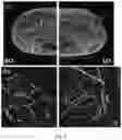 Fig. 06 - PHOTOACOUSTIC BREAST IMAGING SYSTEM AND METHOD